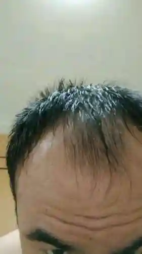 头皮痒 脱发严重怎么办(头皮痒头屑多掉头发怎么办)插图1