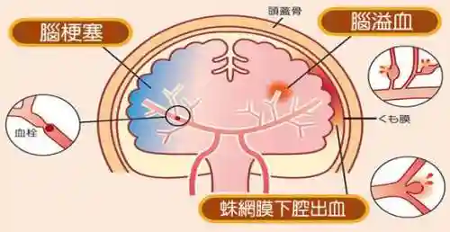 中风的症状和急救措施(中风急救扎手指扎哪里)