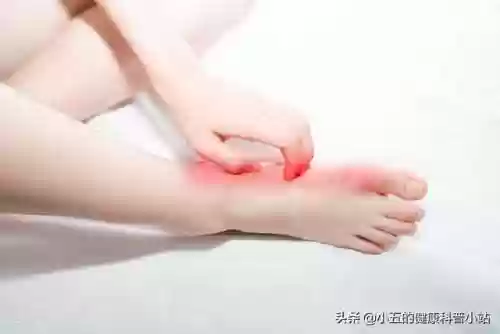 脚气烂脚趾缝痒溃烂如何治疗(脚气发病原因)