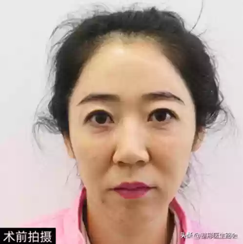 阵容手术图片(全麻手术图片真实)