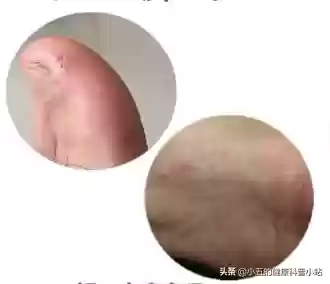 脚气烂脚趾缝痒溃烂如何治疗(脚气发病原因)插图2