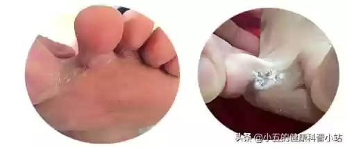 脚气烂脚趾缝痒溃烂如何治疗(脚气发病原因)插图3