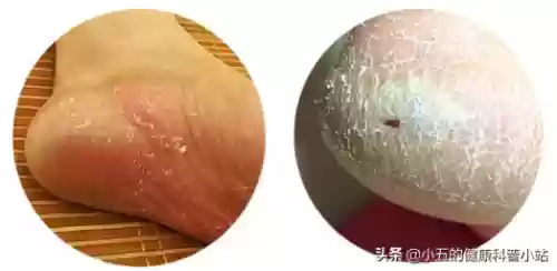 脚气烂脚趾缝痒溃烂如何治疗(脚气发病原因)插图4