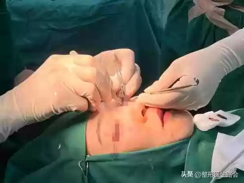 阵容手术图片(全麻手术图片真实)插图5
