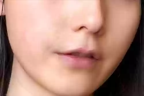 揉自己的痘痘怎样会喷(脸上的痘痘一挤就喷出去了)插图2