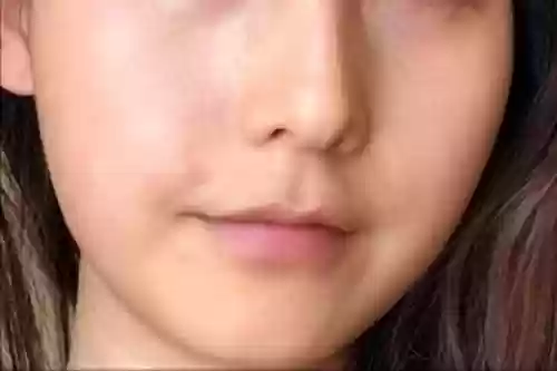 揉自己的痘痘怎样会喷(脸上的痘痘一挤就喷出去了)